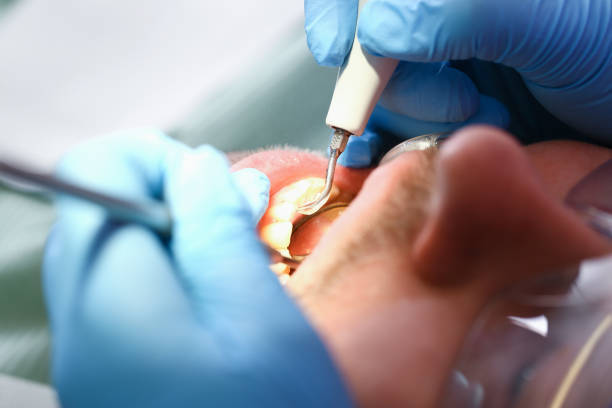Best Emergency Root Canal Treatment in Woodburn, IN