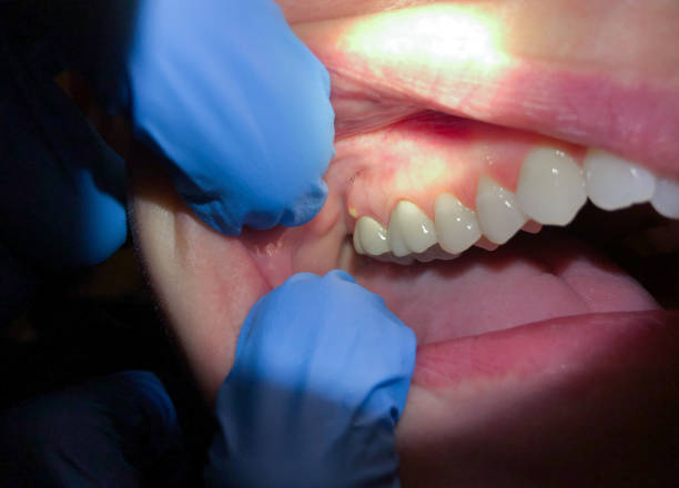 Best Urgent Care for Lost Fillings or Crowns in Woodburn, IN