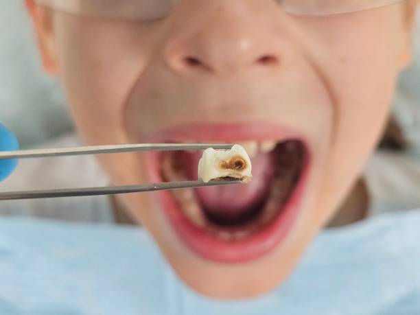 Best Emergency Wisdom Teeth Removal in Woodburn, IN