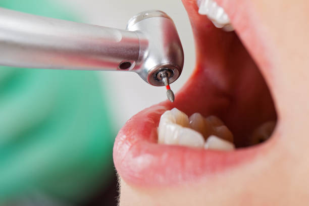 Best Emergency Dental Care for Broken or Chipped Teeth in Woodburn, IN